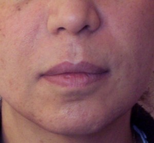 Photo sillons assez marqués immédiatement après injection d'acide hyaluronique